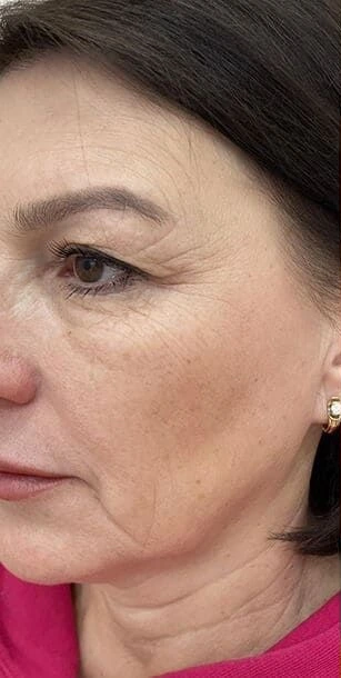 Close-up of fine lines and wrinkles